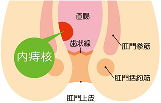 いぼ痔(内痔核)について