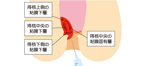 手術不要！切らずに治療するジオン注射（ALTA療法）