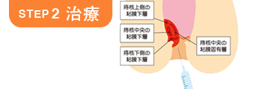 STEP2 治療